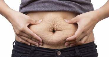 Come prevenire la formazione delle smagliature 